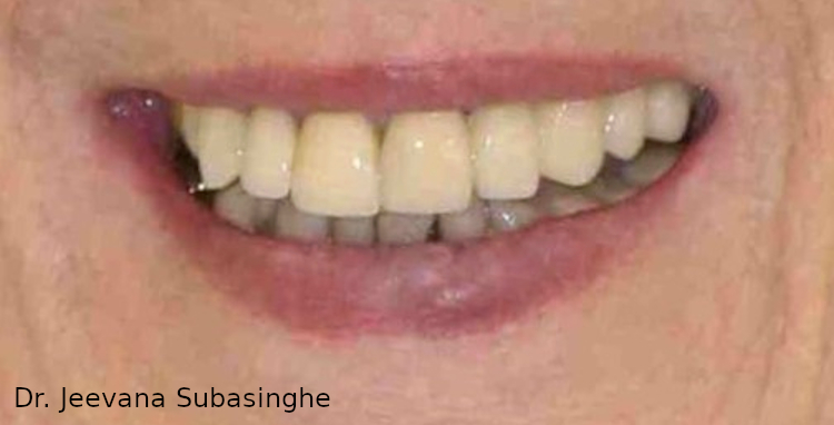 Jeevana-Subasinghe-implant-3-after