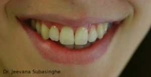 Jeevana-Subasinghe-orthodontics-1-after-300x153