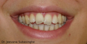Jeevana-Subasinghe-orthodontics-1-before-300x153